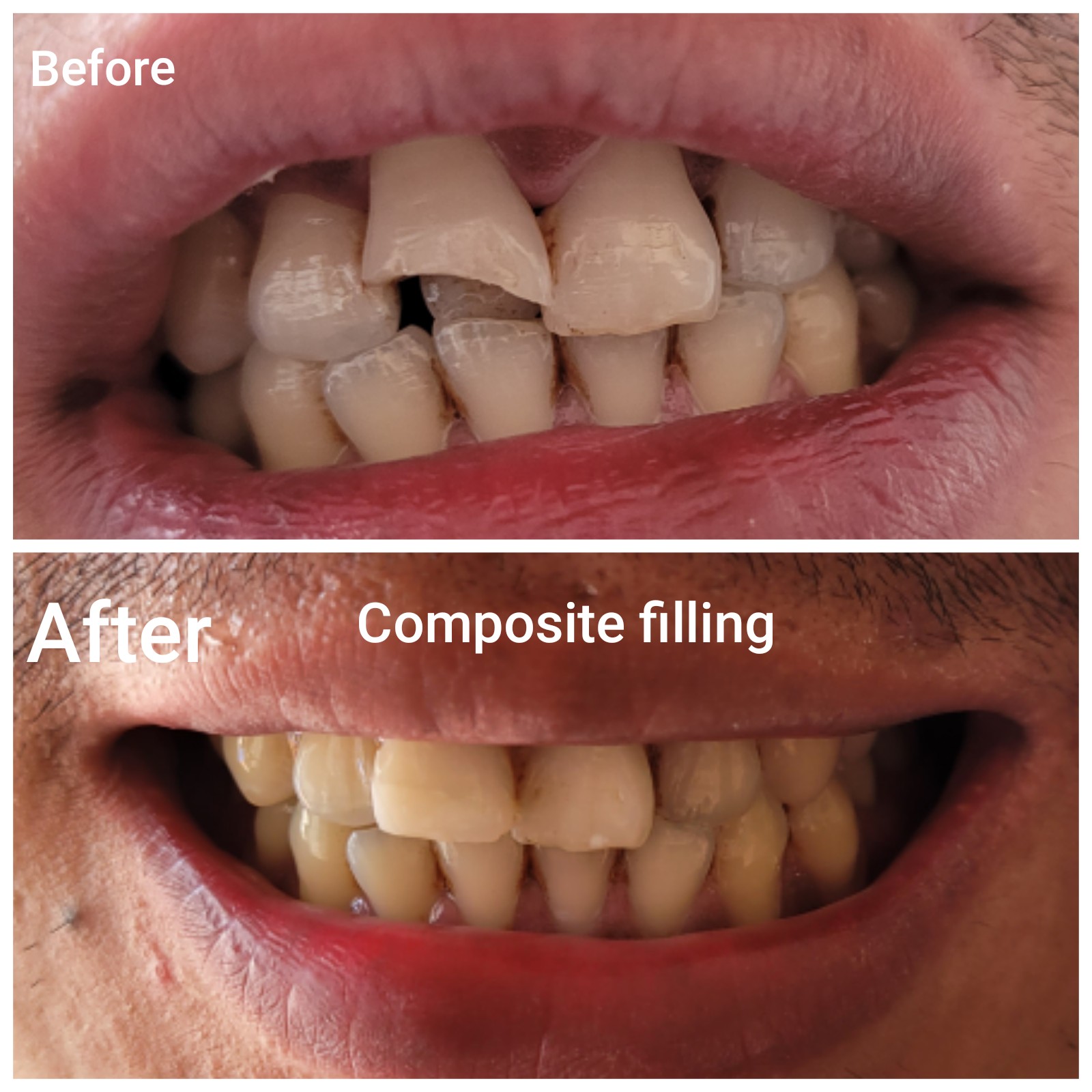 Before and After Front Tooth Composite Restoration
